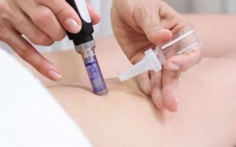 Tratamiento de estrias