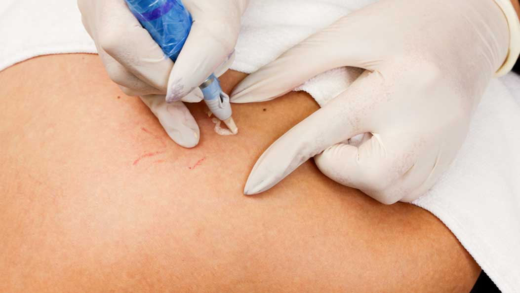 Tratamiento de estrias